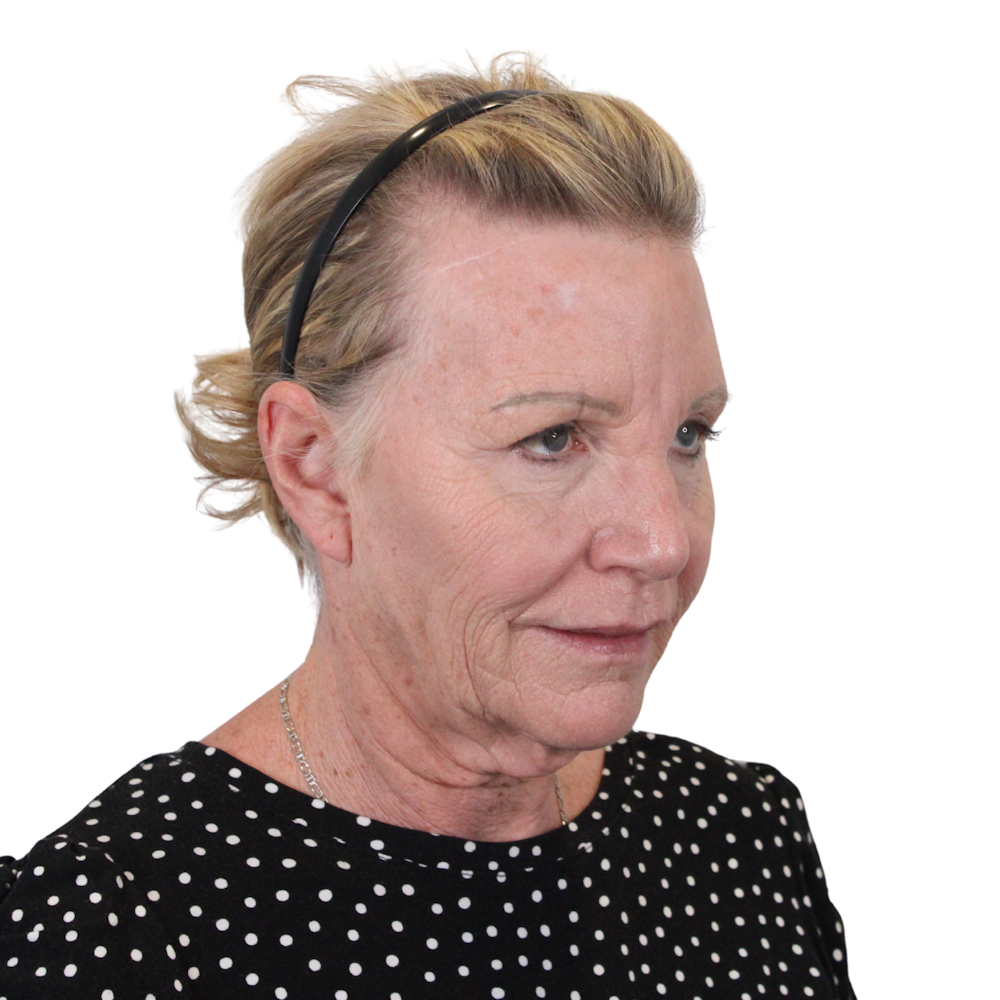 Deep Plane Facelift Before & After Gallery - Patient 428493 - Image 3