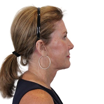 Deep Neck Lift Before & After Gallery - Patient 198424 - Image 8