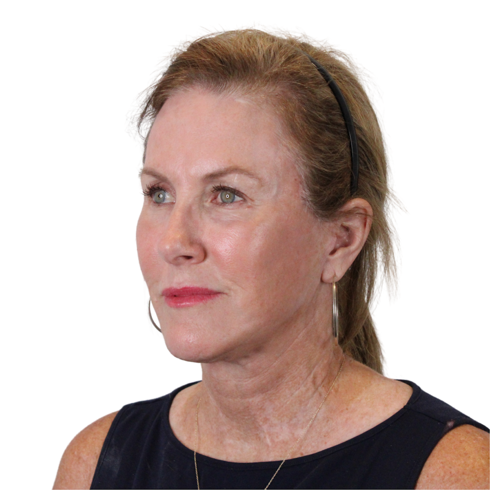 Deep Neck Lift Before & After Gallery - Patient 198424 - Image 6