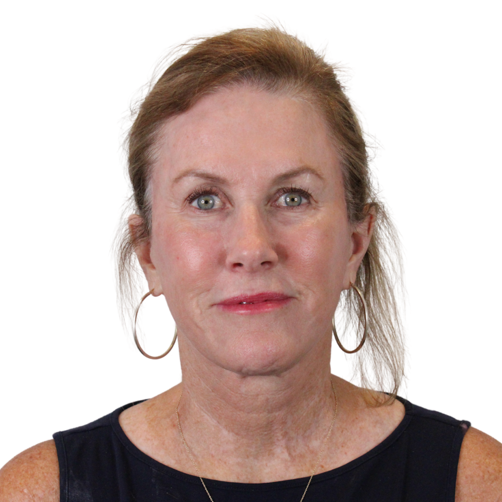 Deep Neck Lift Before & After Gallery - Patient 198424 - Image 2