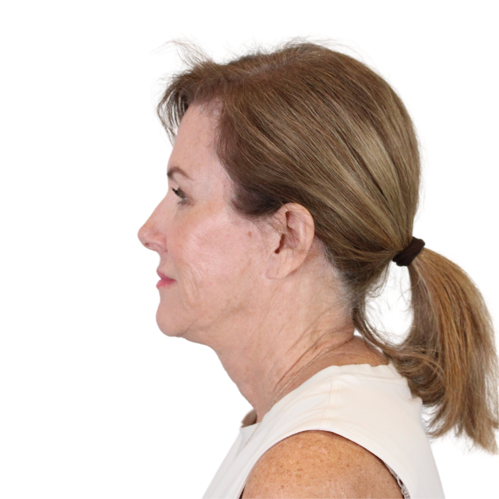 Deep Neck Lift Before & After Gallery - Patient 198424 - Image 9