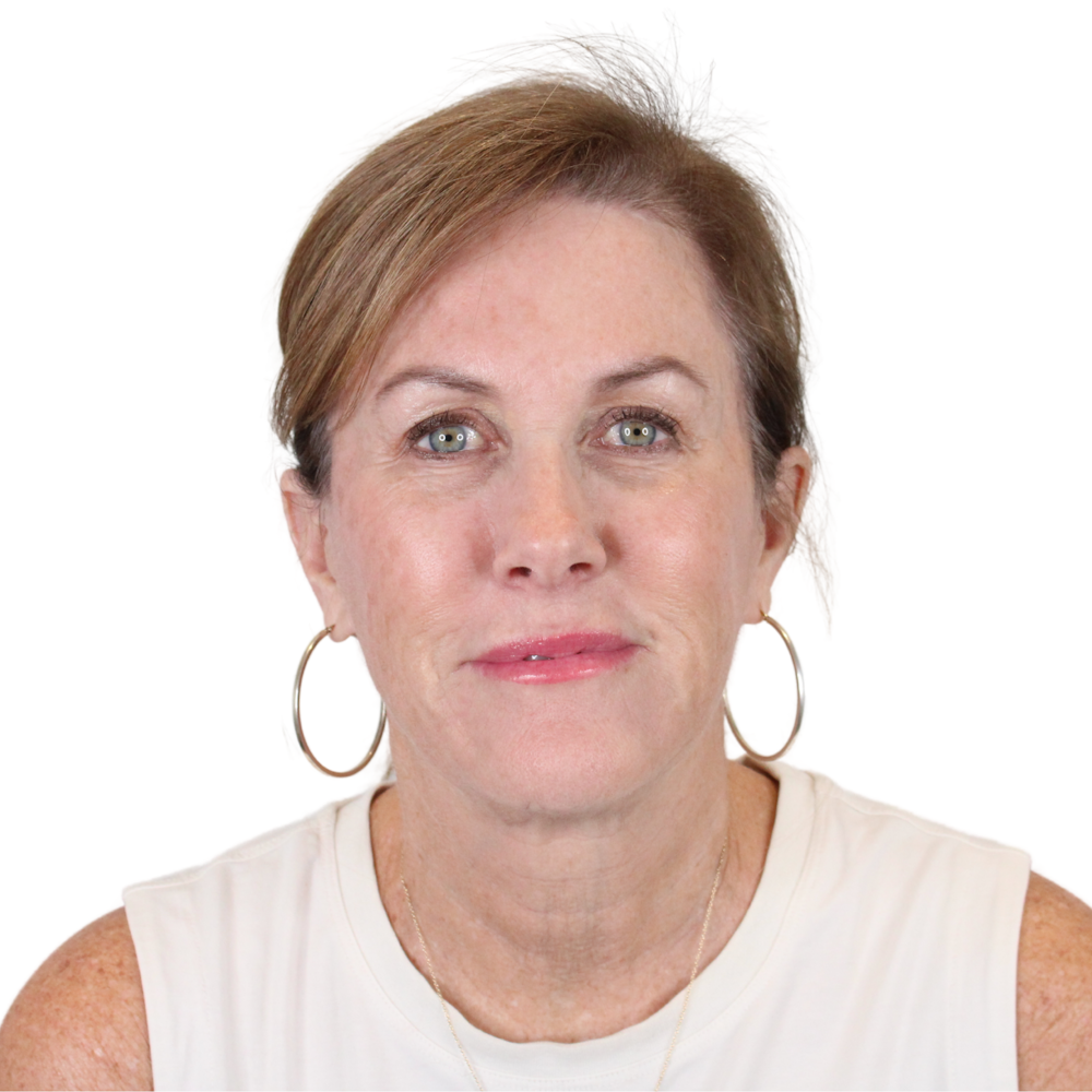 Deep Neck Lift Before & After Gallery - Patient 198424 - Image 1