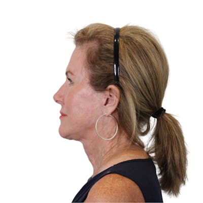 Deep Neck Lift Before & After Gallery - Patient 198424 - Image 10