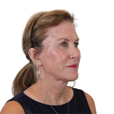 Deep Neck Lift Before & After Gallery - Patient 198424 - Image 4