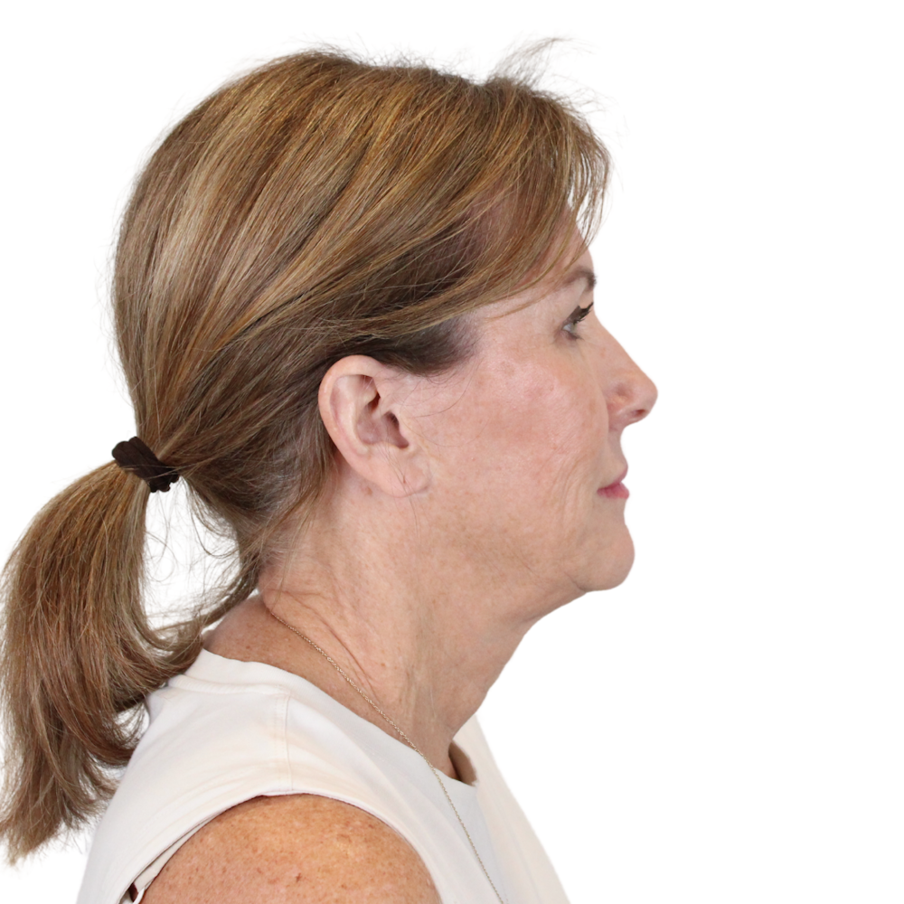 Deep Neck Lift Before & After Gallery - Patient 198424 - Image 7
