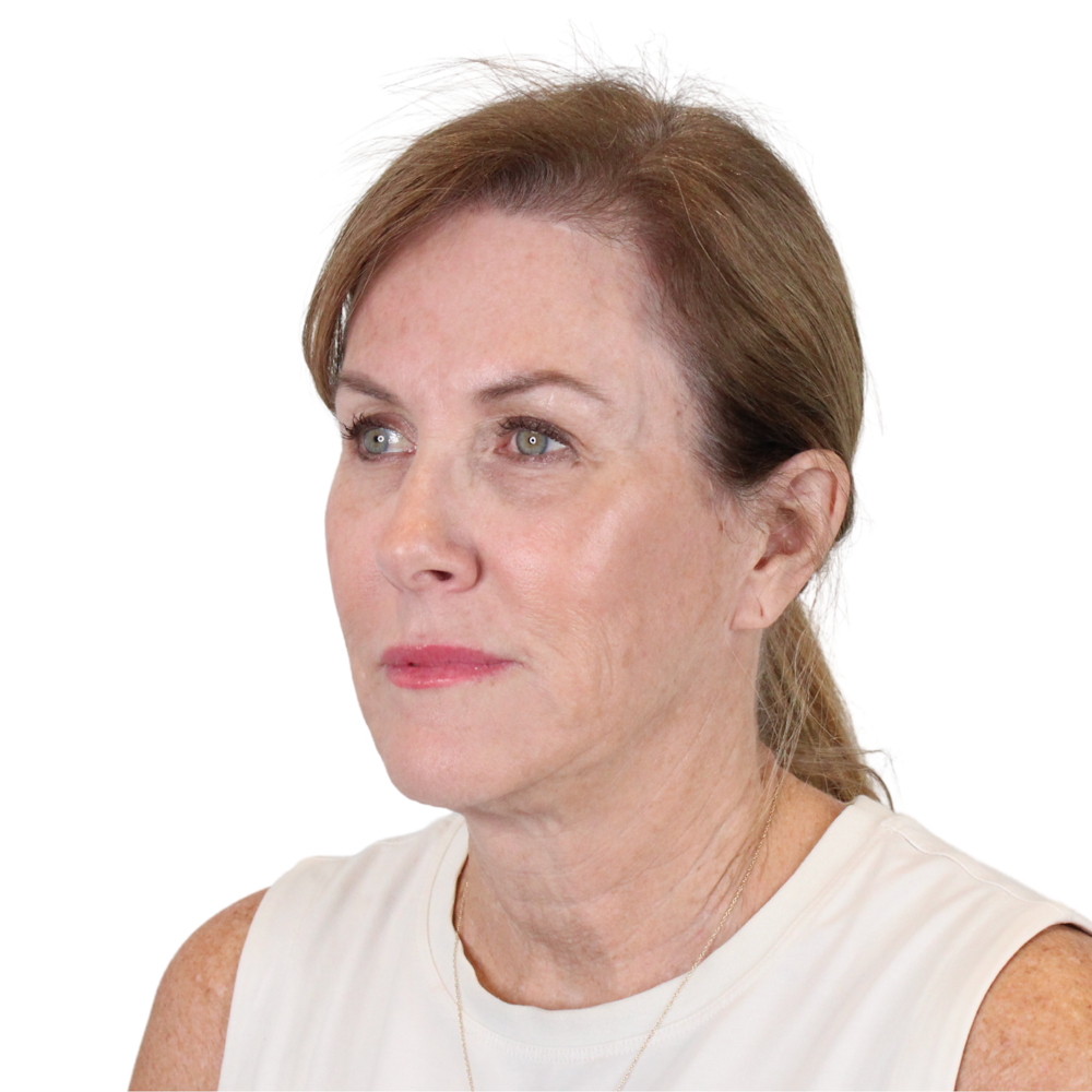 Deep Neck Lift Before & After Gallery - Patient 198424 - Image 5
