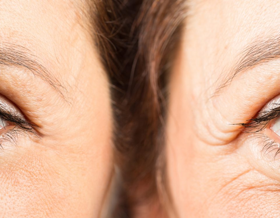 Mangat Copit Plastic Surgery and Skin Care Blog | How To Decide Between Eyelid Surgery Or Brow Lift