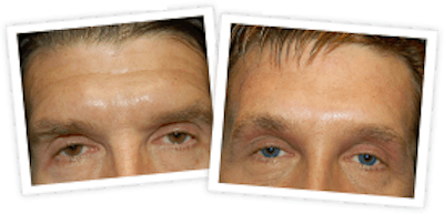 Brow Lift Before & After Gallery - Patient 10380773 - Image 1