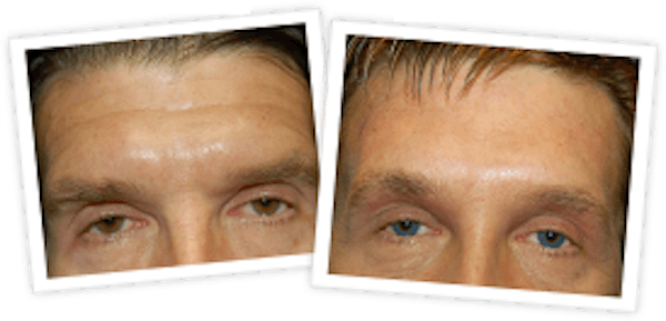 Brow Lift Before & After Gallery - Patient 10380773 - Image 1