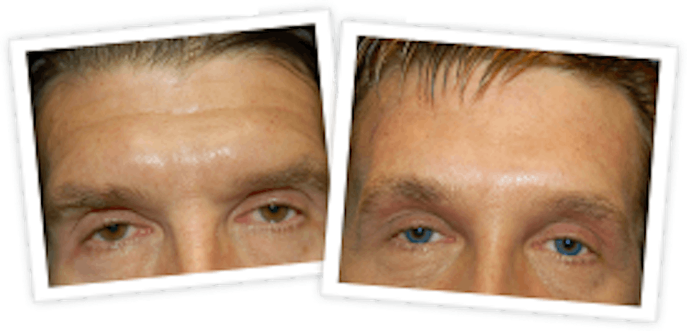 Brow Lift Before & After Gallery - Patient 10380773 - Image 1