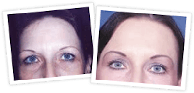Brow Lift Before & After Gallery - Patient 10380772 - Image 1