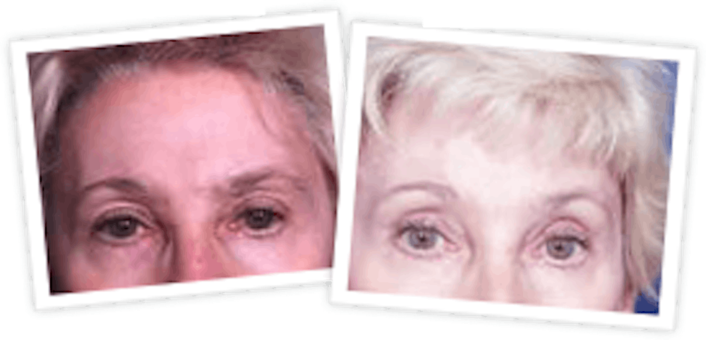 Brow Lift Before & After Gallery - Patient 10380771 - Image 1