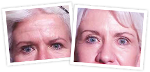 Brow Lift