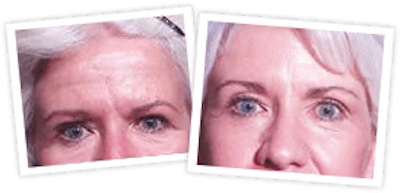 Brow Lift Before & After Gallery - Patient 10380769 - Image 1