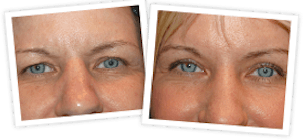 Brow Lift Before & After Gallery - Patient 10380768 - Image 1