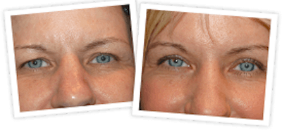 Brow Lift Before & After Gallery - Patient 10380768 - Image 1