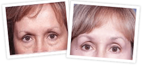 Brow Lift Before & After Gallery - Patient 10380767 - Image 1
