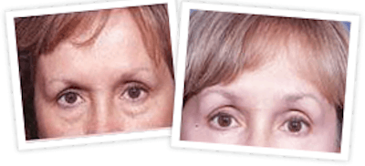 Brow Lift Before & After Gallery - Patient 10380767 - Image 1
