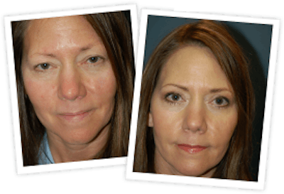 Rhinoplasty Before & After Gallery - Patient 10380754 - Image 1