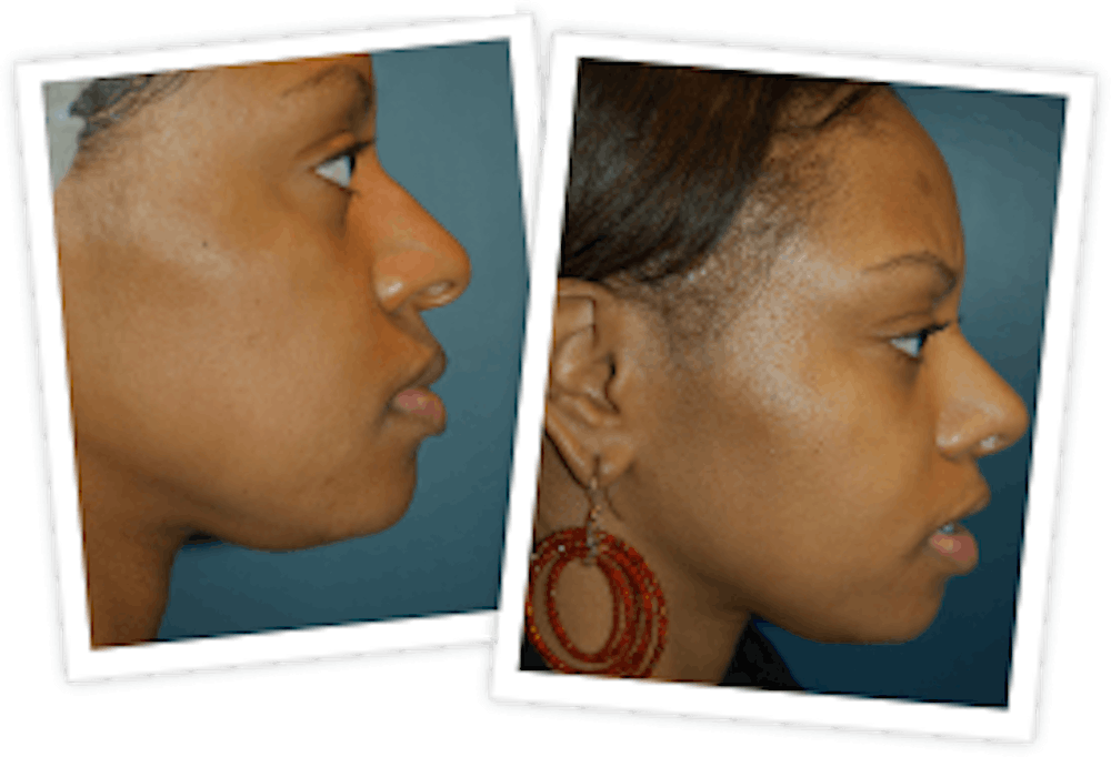 Rhinoplasty Before & After Gallery - Patient 10380753 - Image 1