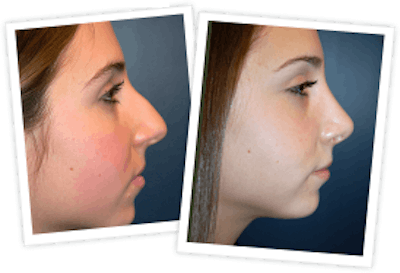 Rhinoplasty Before & After Gallery - Patient 10380752 - Image 2