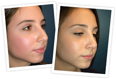 Rhinoplasty Before & After Gallery - Patient 10380752 - Image 1