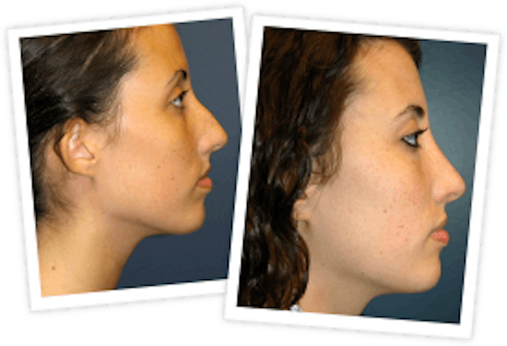 Rhinoplasty Before & After Gallery - Patient 10380751 - Image 1