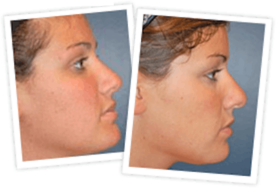 Rhinoplasty Before & After Gallery - Patient 10380539 - Image 2