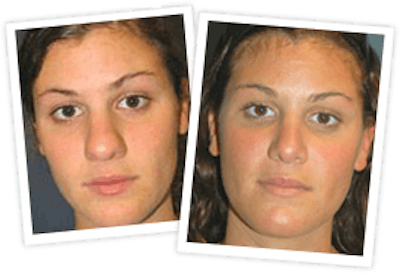 Rhinoplasty Before & After Gallery - Patient 10380539 - Image 1