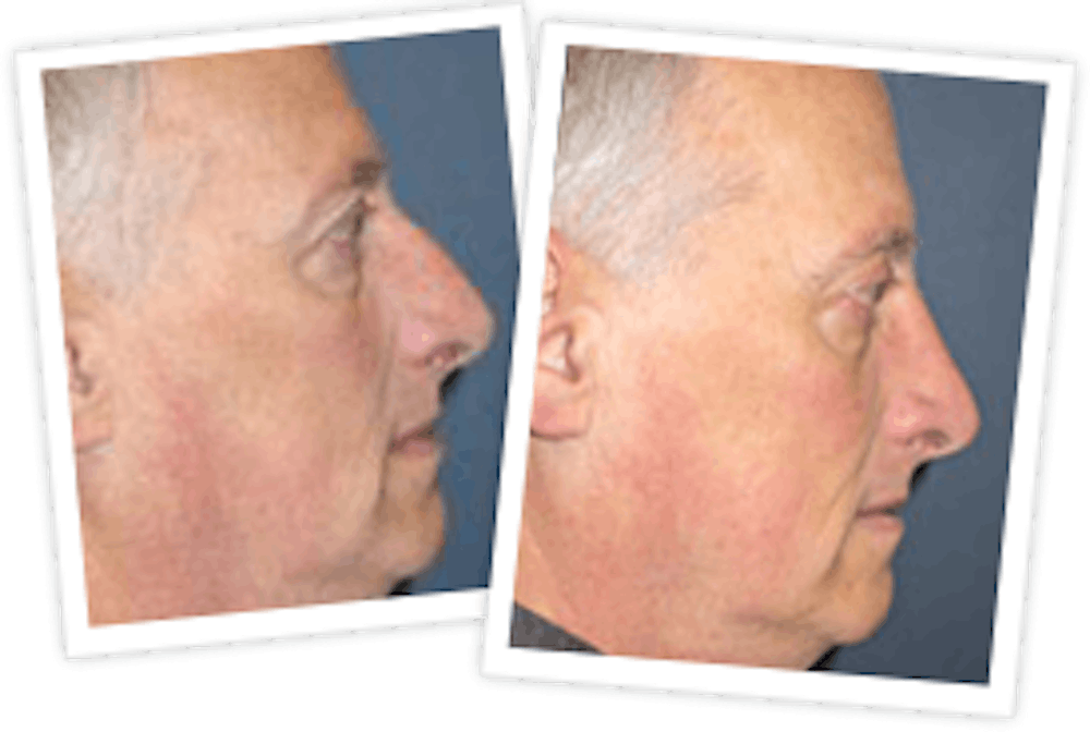 Rhinoplasty Before & After Gallery - Patient 10380535 - Image 1
