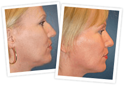 Rhinoplasty Before & After Gallery - Patient 10380538 - Image 1