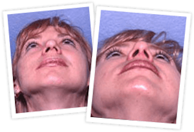 Rhinoplasty Before & After Gallery - Patient 10380533 - Image 1