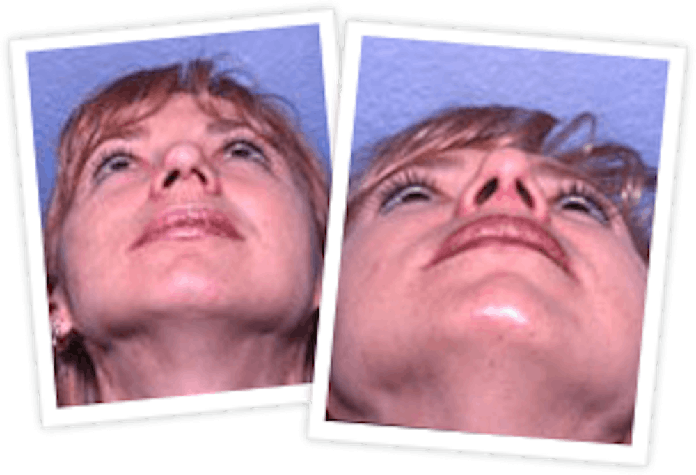 Rhinoplasty Before & After Gallery - Patient 10380533 - Image 1