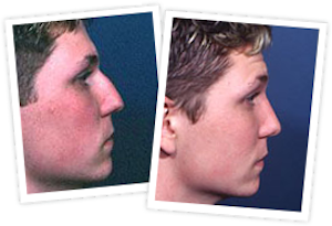 Rhinoplasty