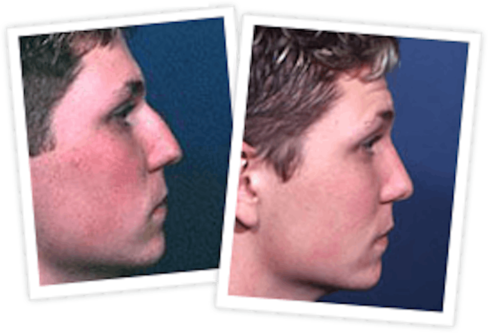 Rhinoplasty Before & After Gallery - Patient 10380532 - Image 1