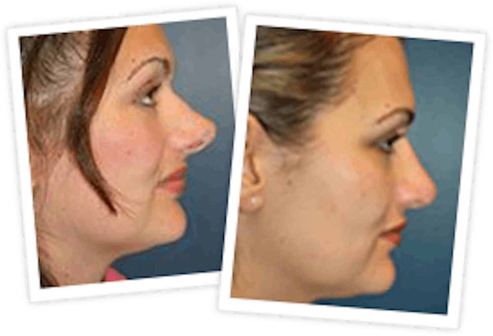 Rhinoplasty Before & After Gallery - Patient 10380531 - Image 1