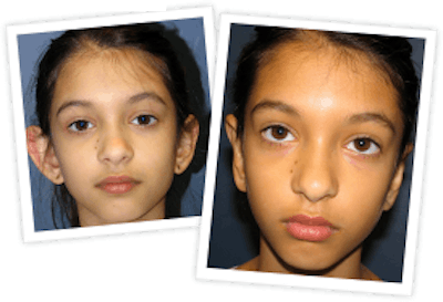 Ear Pinning Before & After Gallery - Patient 10380480 - Image 1