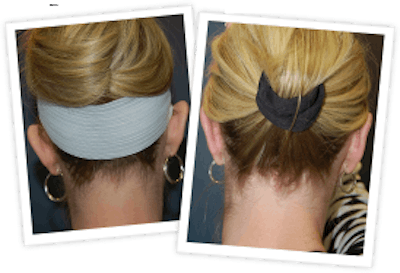 Ear Pinning Before & After Gallery - Patient 10380481 - Image 1