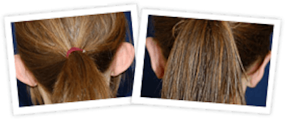 Ear Pinning Before & After Gallery - Patient 10380479 - Image 1