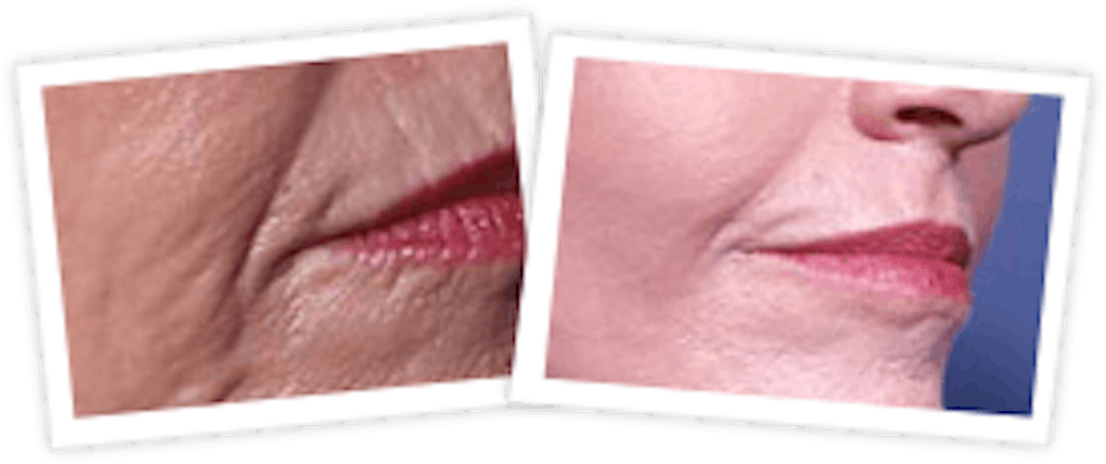 Chemical Peel / Skin Resurfacing Before & After Gallery - Patient 10380760 - Image 1