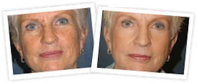 Chemical Peel / Skin Resurfacing Before & After Gallery - Patient 10380761 - Image 1