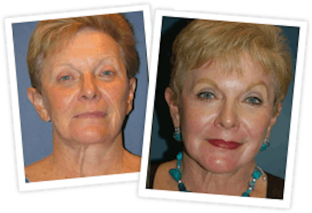 Chemical Peel / Skin Resurfacing Before & After Gallery - Patient 10380758 - Image 1