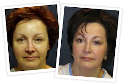 Skin Resurfacing
