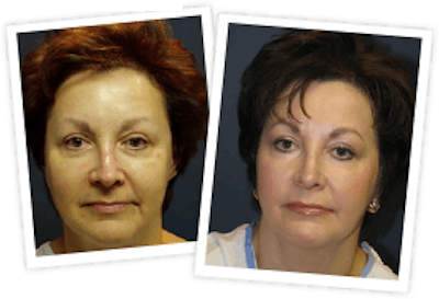 Chemical Peel / Skin Resurfacing Before & After Gallery - Patient 10380757 - Image 1
