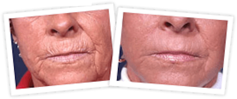 Chemical Peel / Skin Resurfacing Before & After Gallery - Patient 10380759 - Image 1