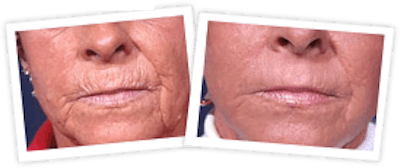 Chemical Peel / Skin Resurfacing Before & After Gallery - Patient 10380759 - Image 1