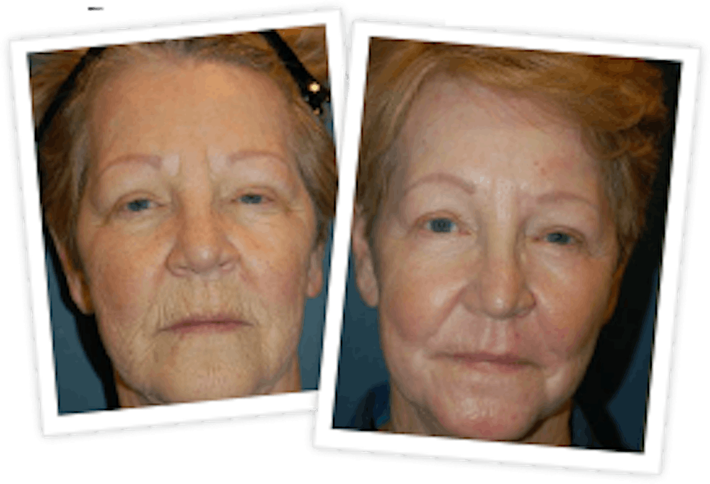 Chemical Peel / Skin Resurfacing Before & After Gallery - Patient 10380756 - Image 1