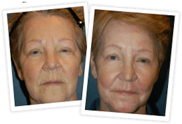 Chemical Peel / Skin Resurfacing Before & After Gallery - Patient 10380756 - Image 1
