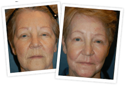 Chemical Peel / Skin Resurfacing Before & After Gallery - Patient 10380756 - Image 1