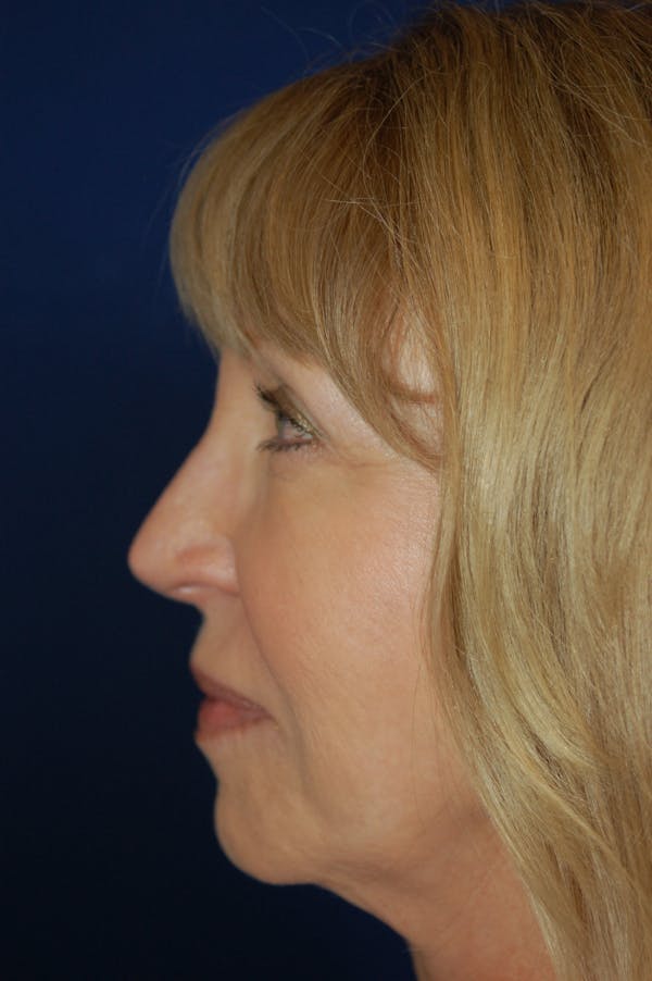 Chin & Cheek Augmentation Before & After Gallery - Patient 10380365 - Image 3